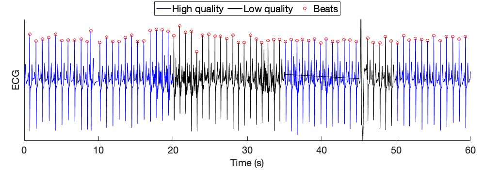1-minute ECG signal and detected beats and quality